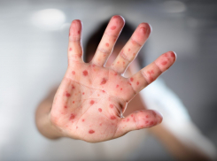 В регионе продолжает расти число заболевших корью